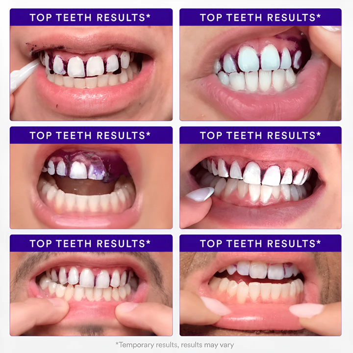 Purple Teeth Whitening Strips